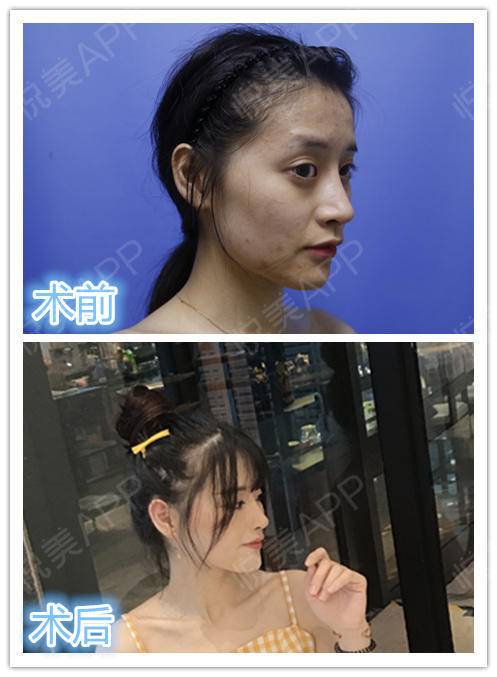 朋友说我有点高冷女神范儿现在脸型流畅,属于当下正...磨骨悦美整形